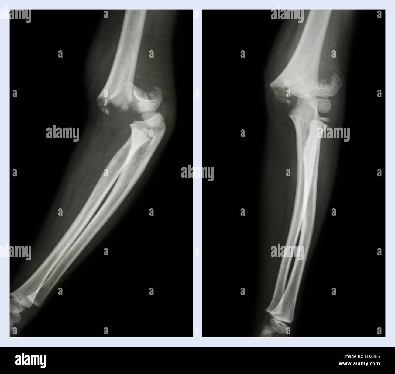 Fracture elbow (Left image : side position , Right image : front position) Stock Photo