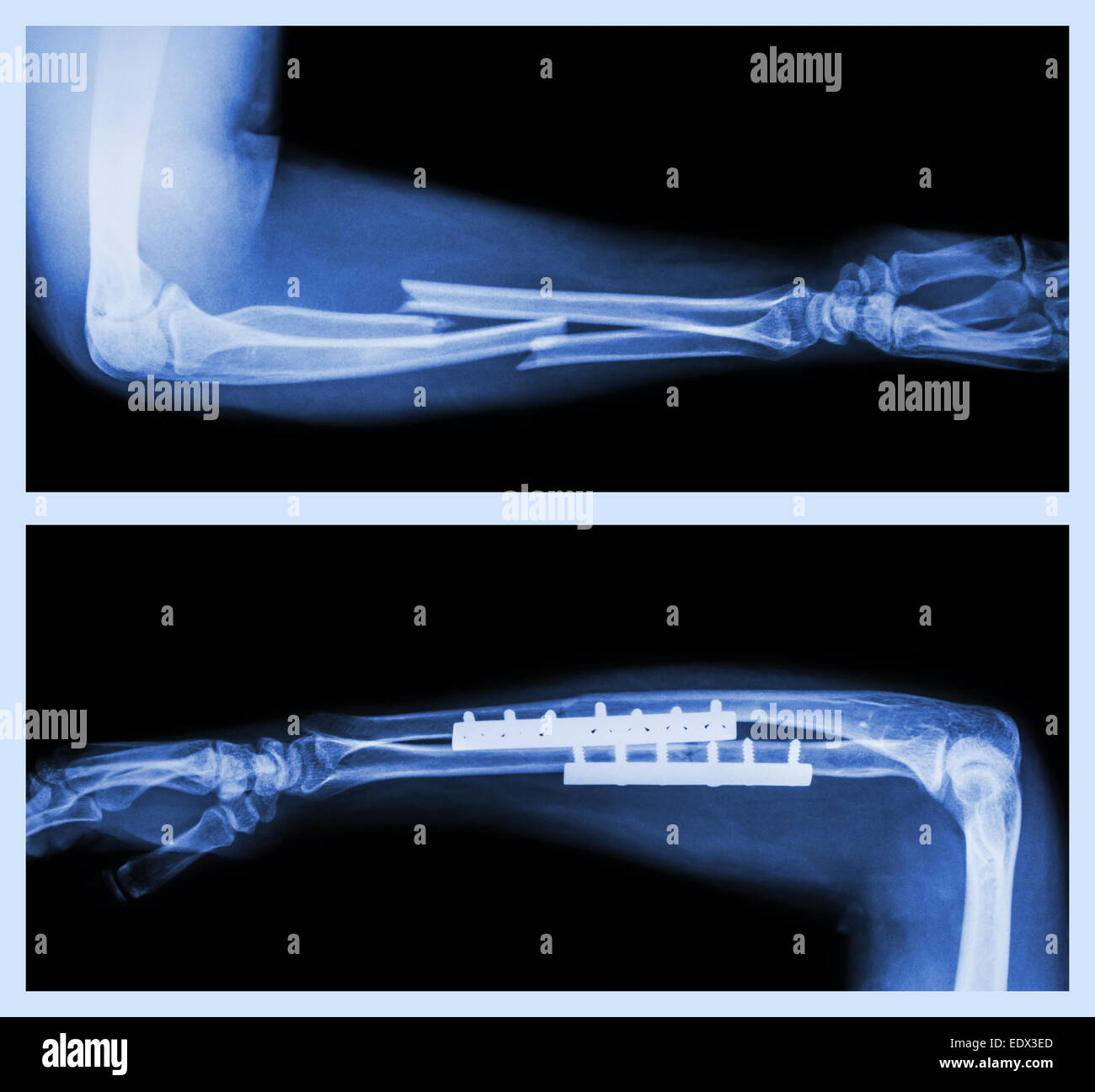 Upper image : Fracture ulnar and radius (Forearm bone) , Lower image : It was operated and internal fixed with plate and screw Stock Photo