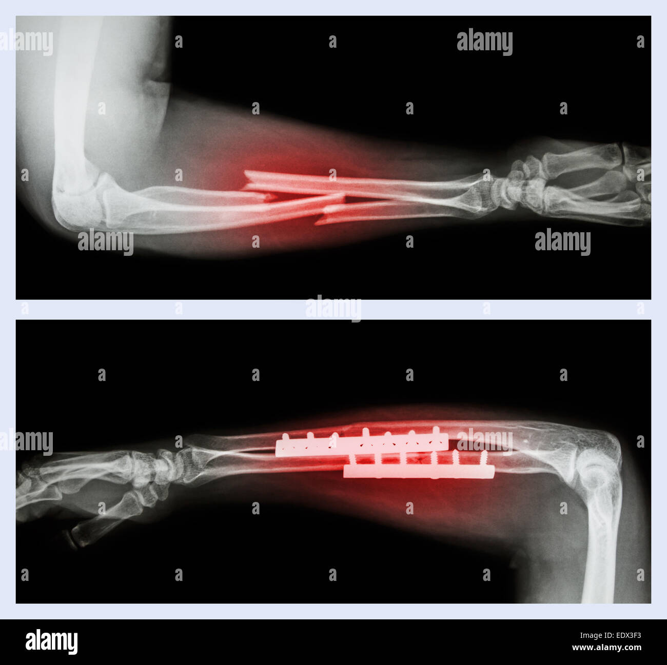 Upper image : Fracture ulnar and radius (Forearm bone) , Lower image : It was operated and internal fixed with plate and screw Stock Photo