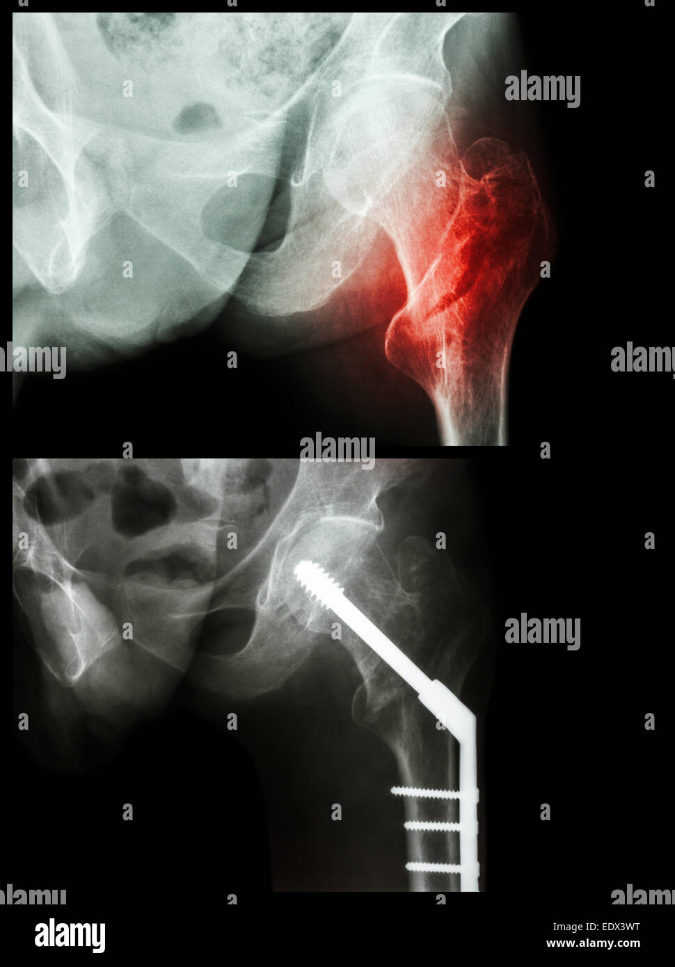 Fractured Neck of Femur | FNOF | Orthopaedics | Geeky Medics