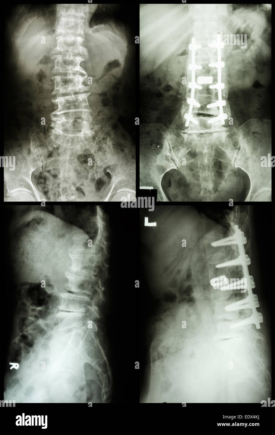 'Spondylosis and Spondylolisthesis'  It was operated and internal fixed at spine ( before and after operated ) Stock Photo