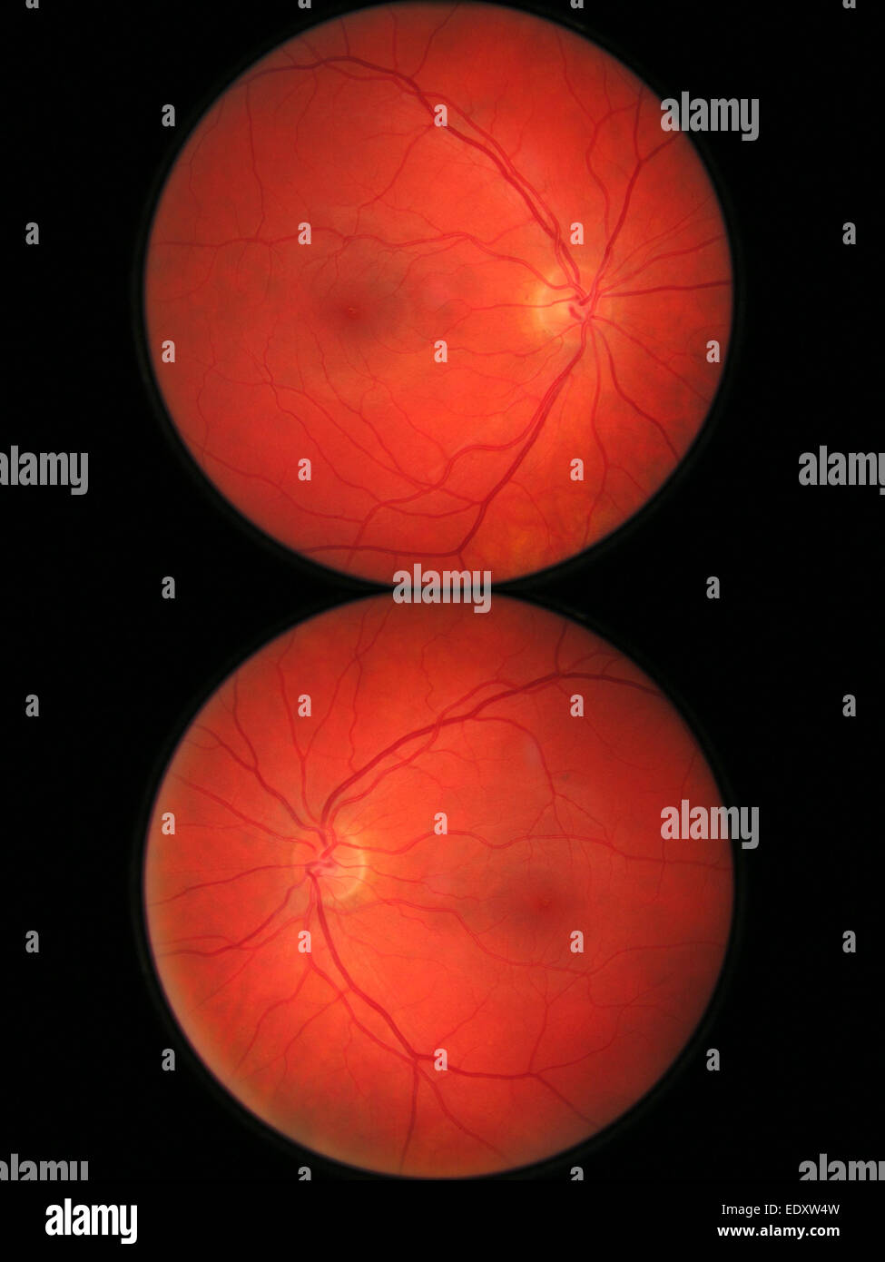 photograph of two healthy eye retinas Stock Photo