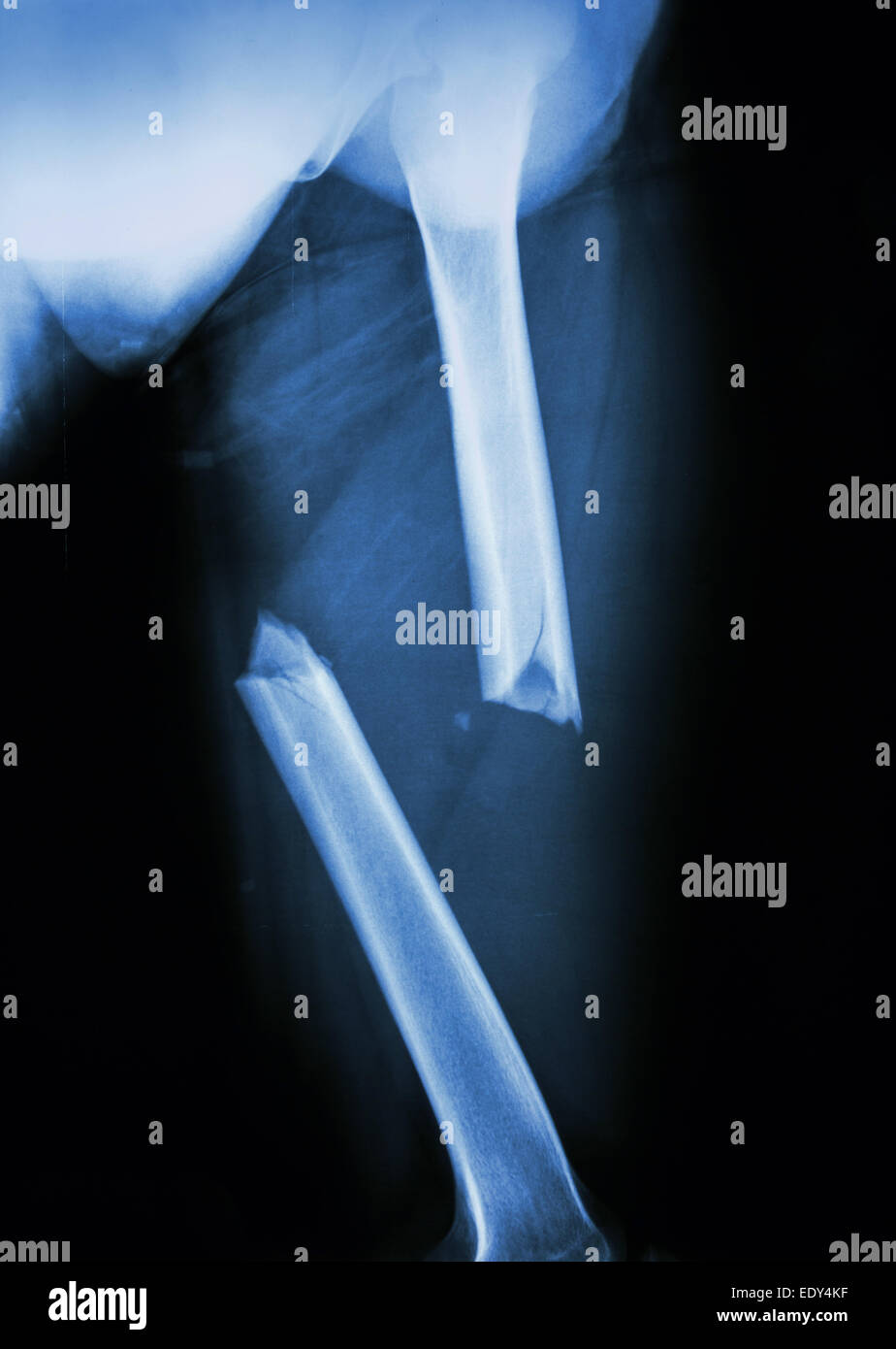 Film X-ray Left femur(left thigh) show complete fracture shaft of femur and displace Stock Photo
