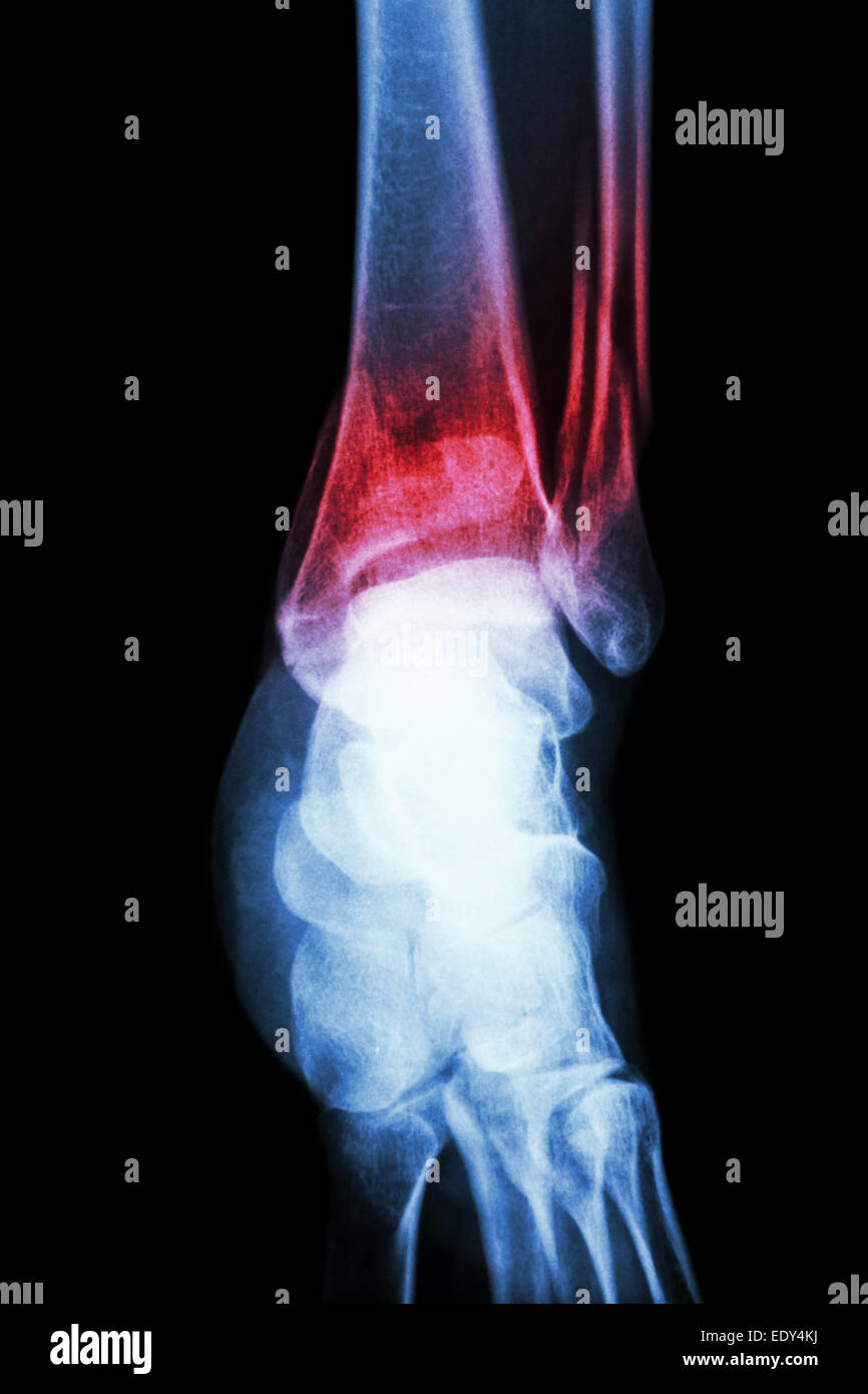 film x-ray ankle show fracture distal tibia and fibula (leg's bone) Stock Photo