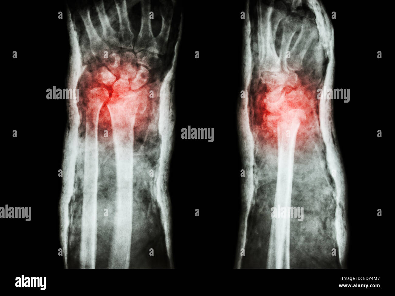 fracture distal radius (Colles' fracture) and cast (Front & Side Stock