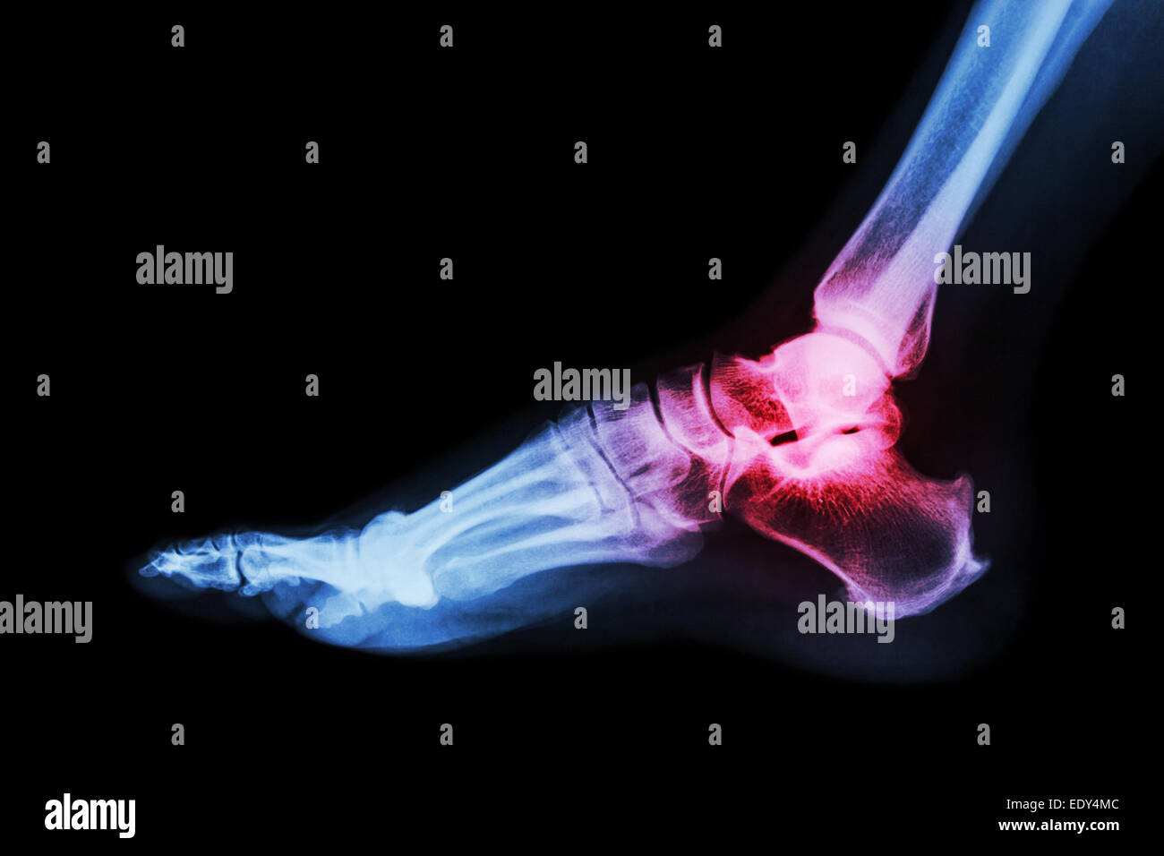 Arthritis at ankle joint (Gout , Rheumatoid arthritis) Stock Photo