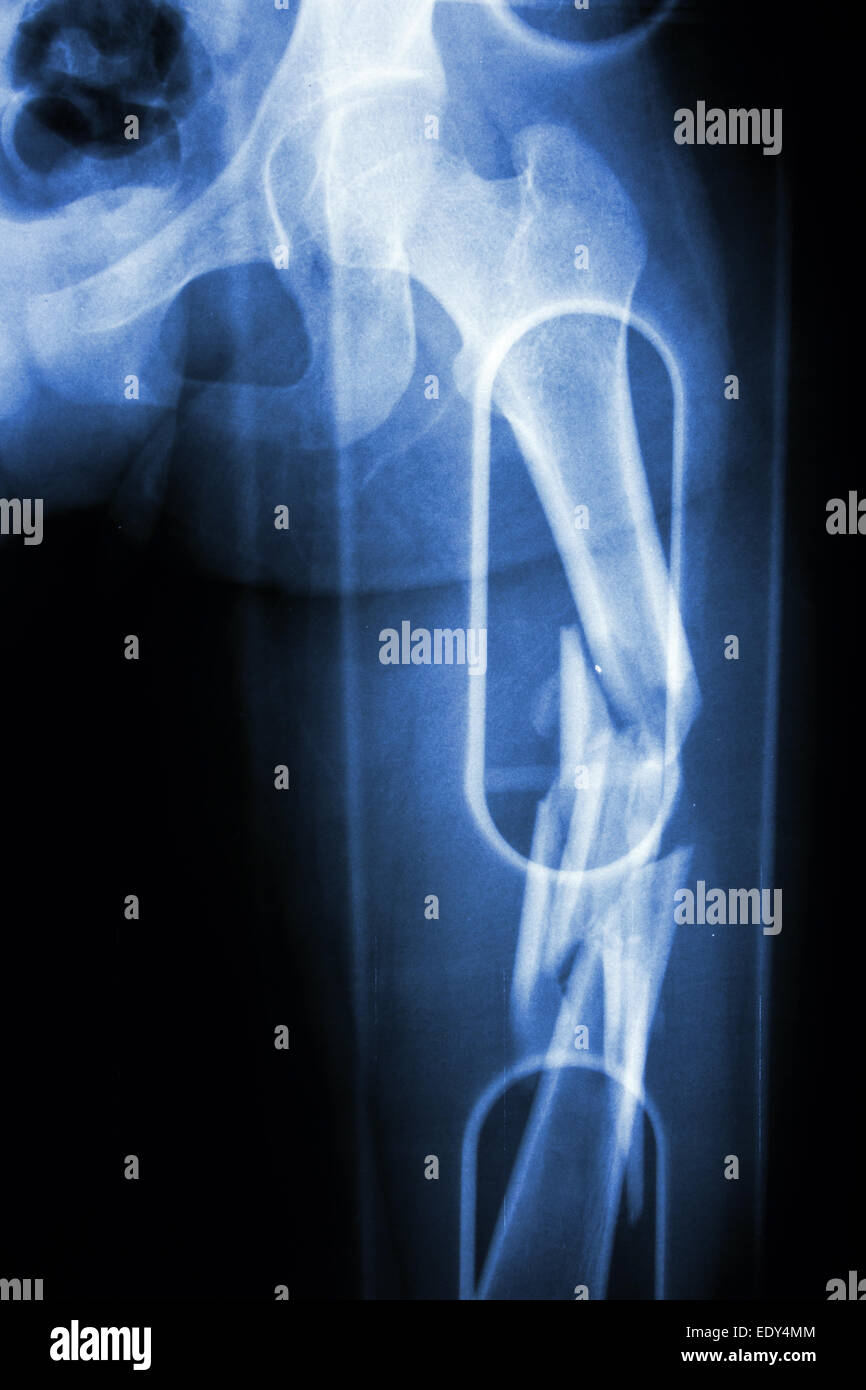 Film X-ray show comminute fracture shaft of femur (thigh bone). It was spliced Stock Photo