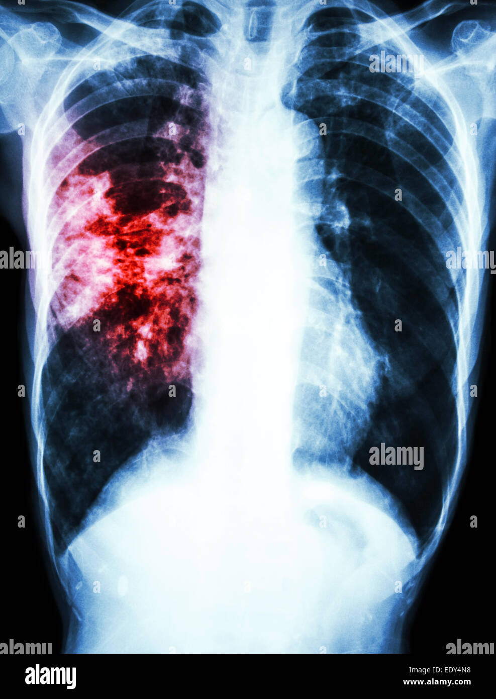 film chest xray show alveolar infiltrate at right lung due to Mycobacterium tuberculosis