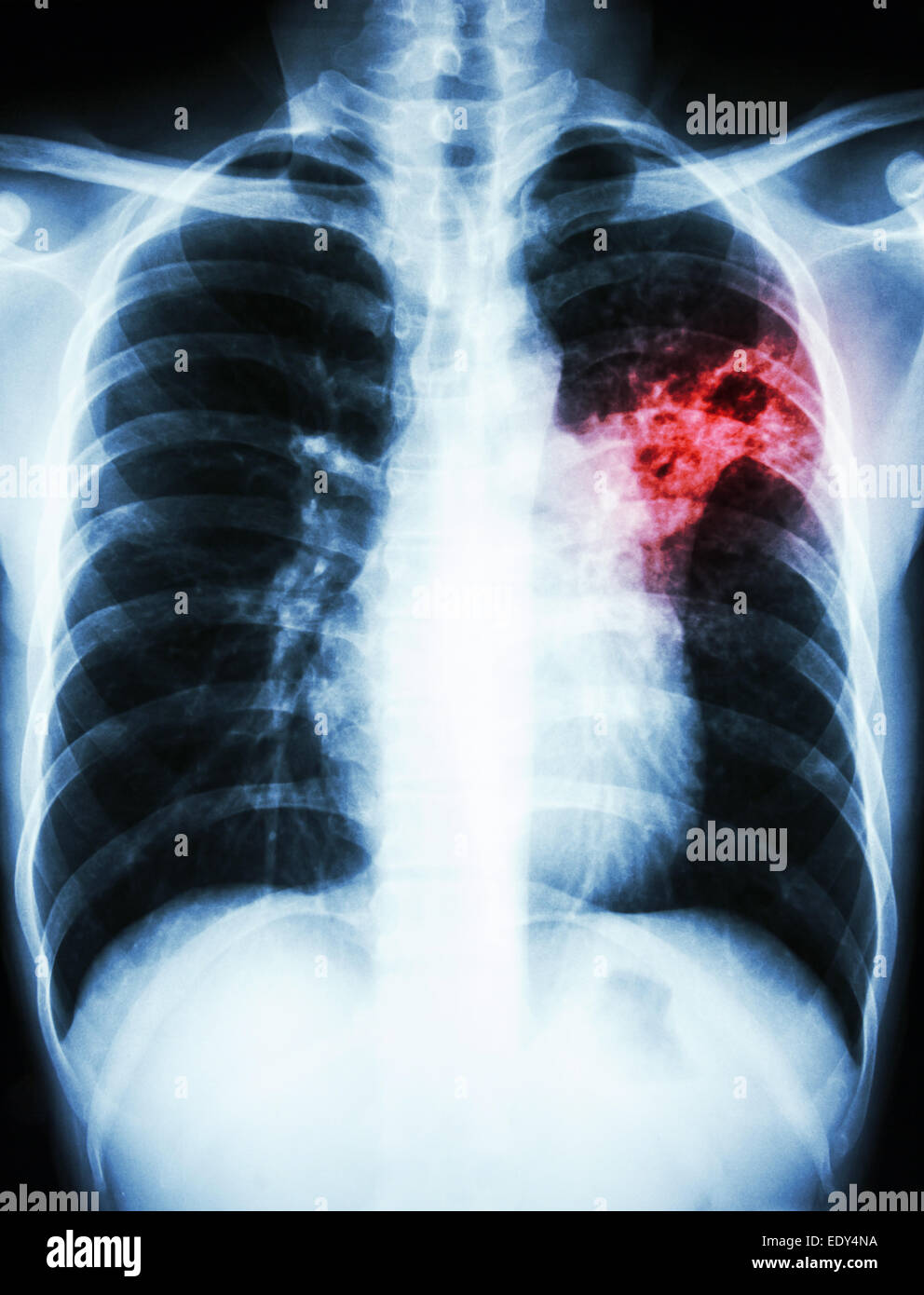 film chest xray show alveolar infiltrate at left middle lung due to