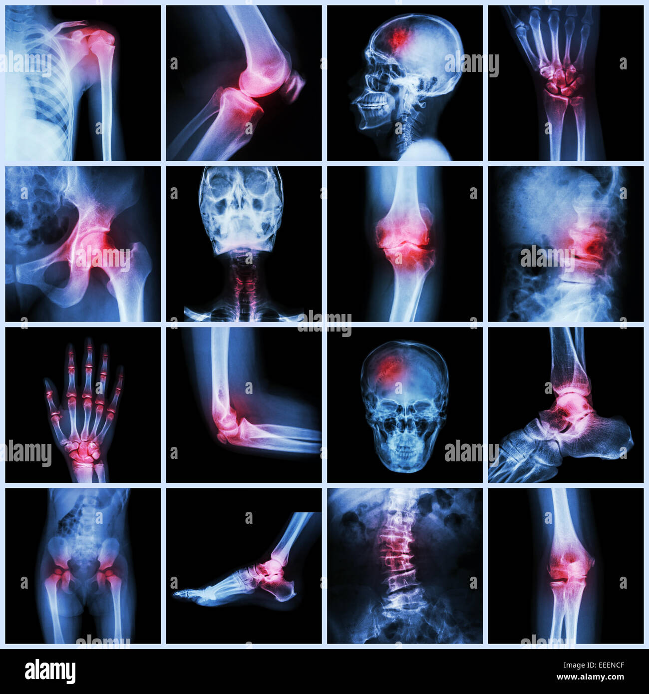Collection human joint and arthritis and stroke ( skull head neck shoulder chest thorax shoulder arm elbow forearm wrist hand fi Stock Photo
