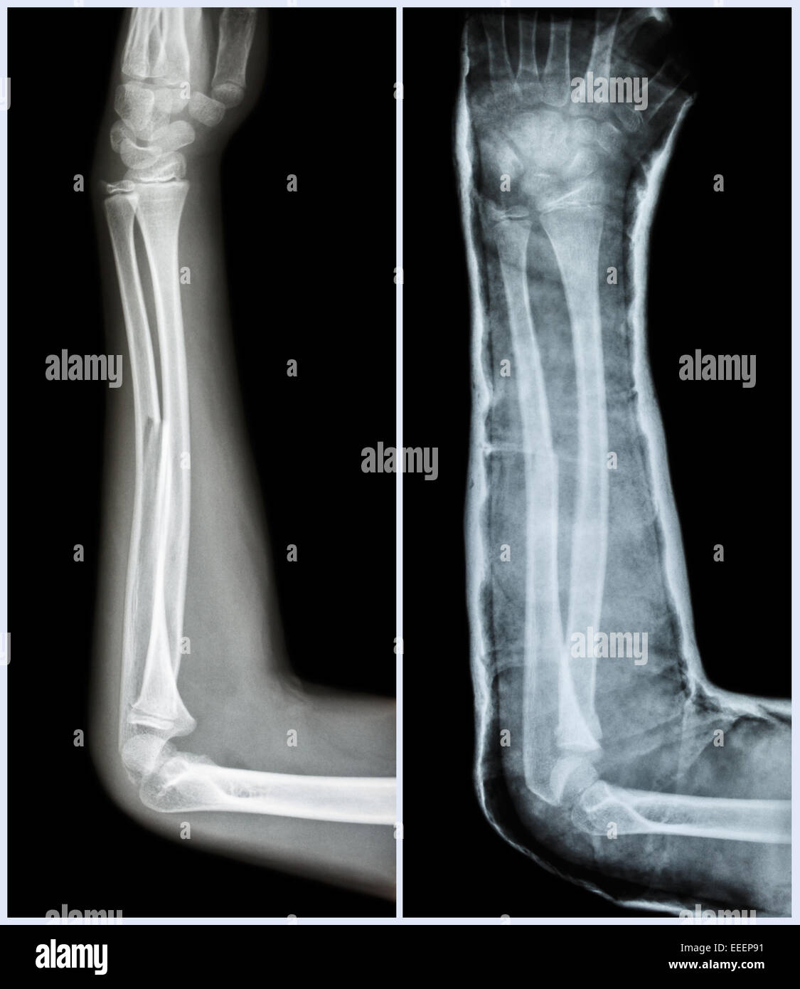 Fracture shaft of ulnar bone ( forearm bone ) ( Left pretreatment