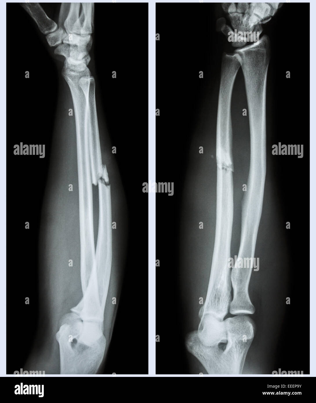 X-ray forearm (  front , side ) : Comminuted fracture shaft of ulnar bone ( forearm bone ) Stock Photo