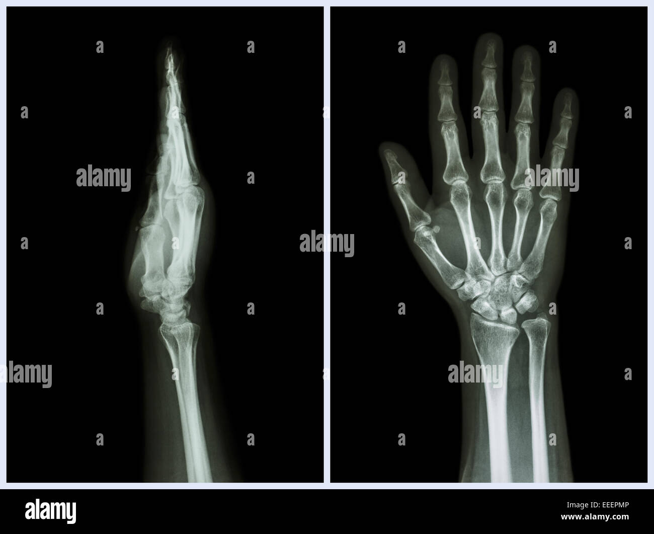 XRay Hands ( front & side view ) Normal human hands Stock Photo Alamy