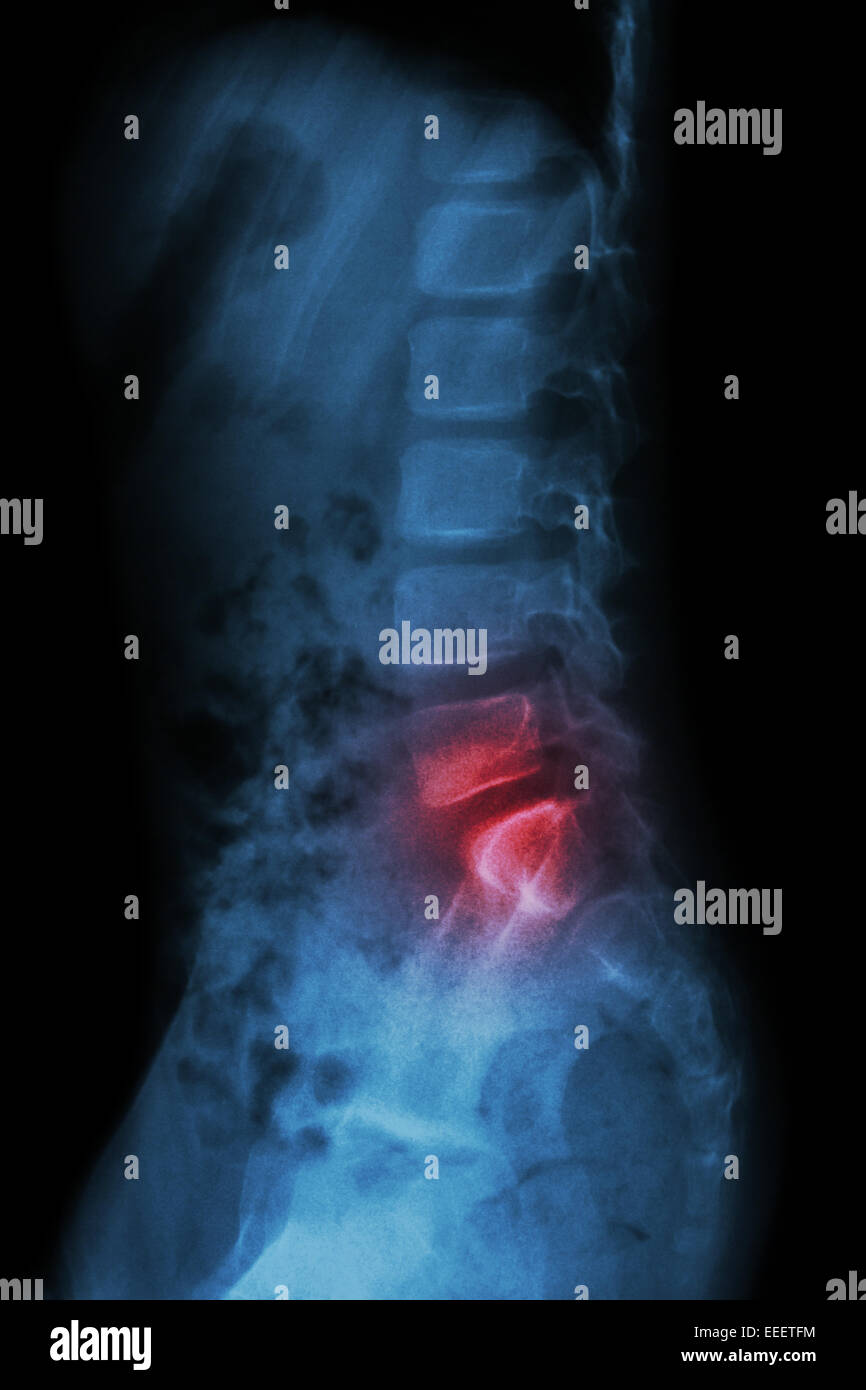 Lumbar spine of child and inflammation at lumbar spine ( low back pain ) ( X-ray thoracic - lumbar spine ) ( lateral view ) Stock Photo