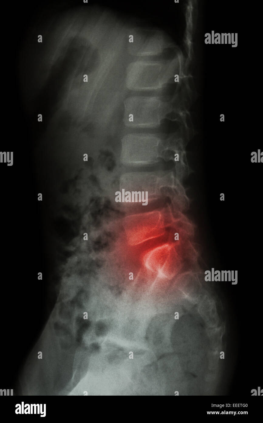 Lumbar spine of child and inflammation at lumbar spine ( low back pain ) ( X-ray thoracic - lumbar spine ) ( lateral view ) Stock Photo