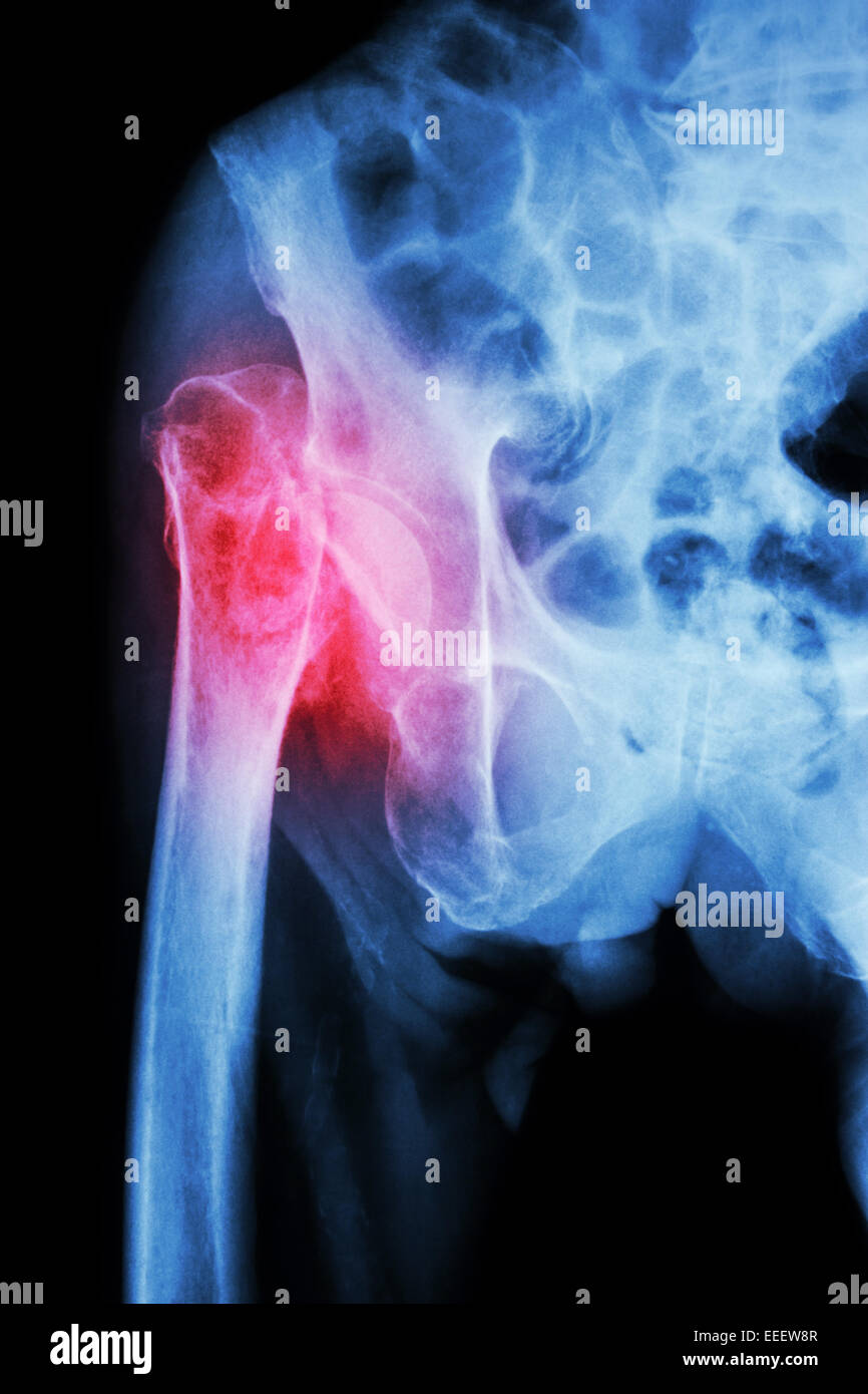 X-ray pelvis & hip joint  : Fracture head of femur (thigh bone) Stock Photo