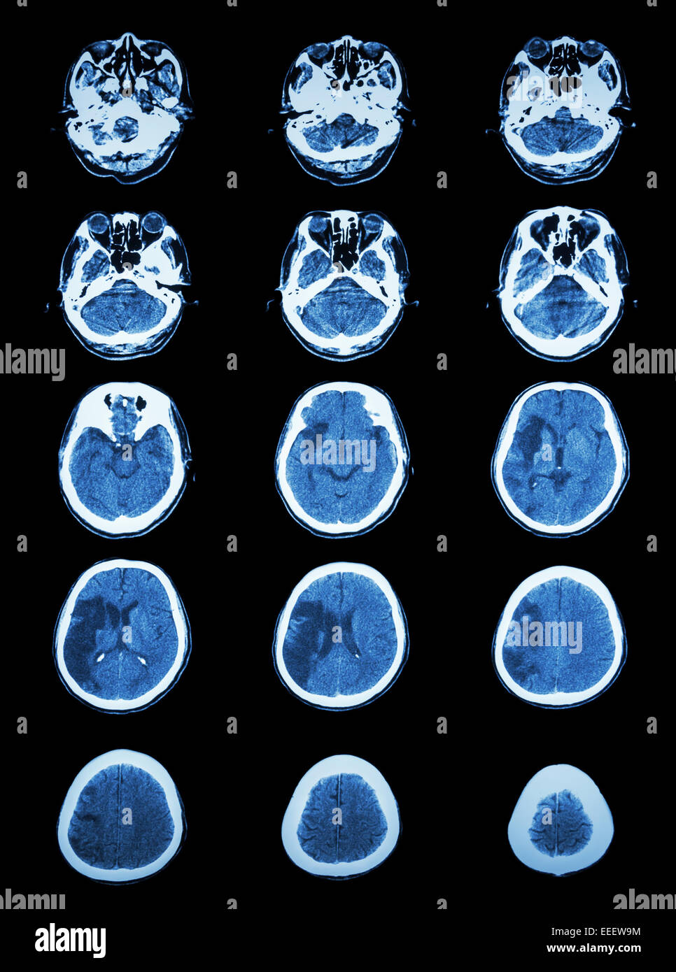 CT scan (computed tomography) of brain show cerebral infarction at right temporal-parietal lobe  ( ischemic stroke ) Stock Photo