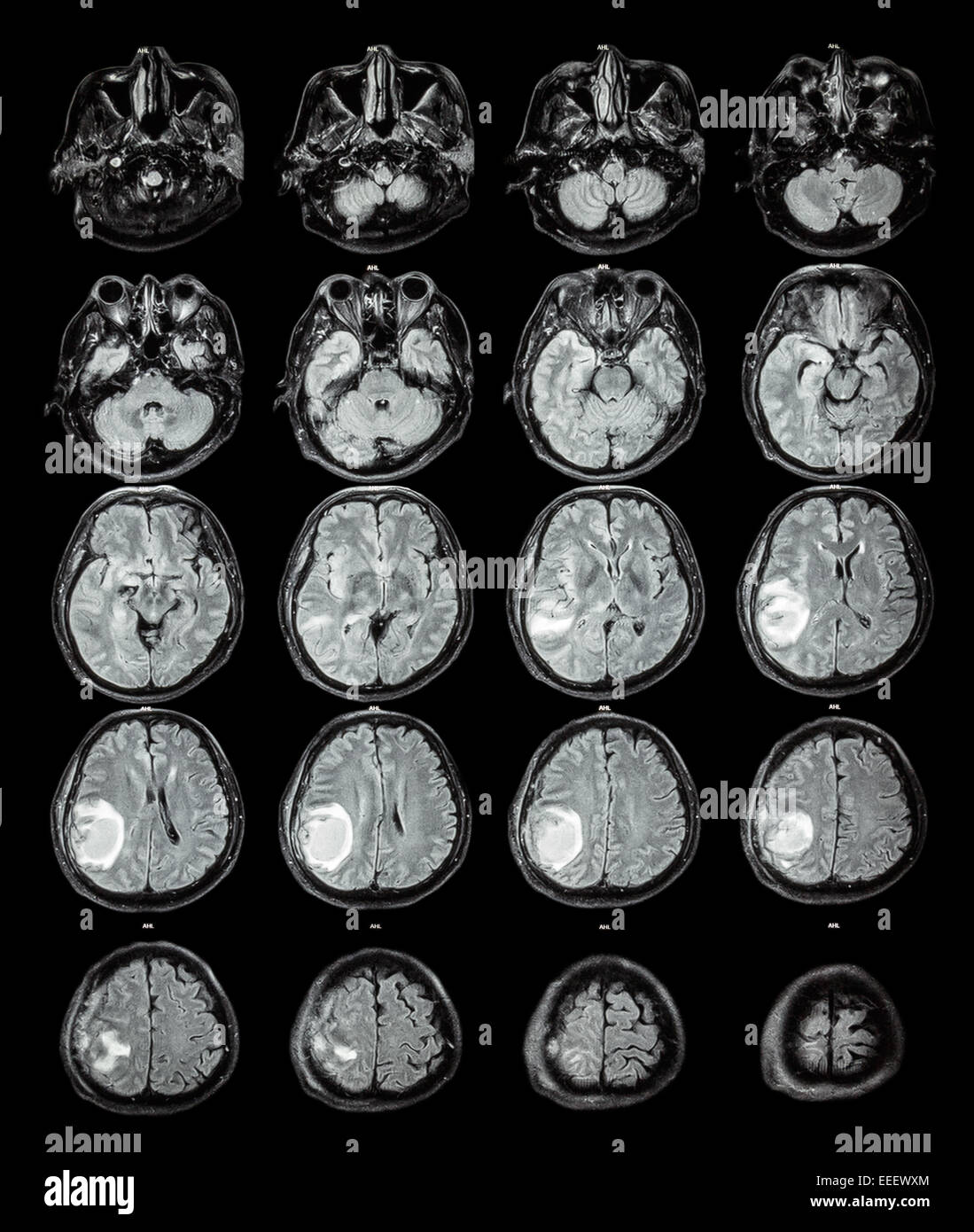 MRI brain : Brain tumor at right parietal lobe Stock Photo