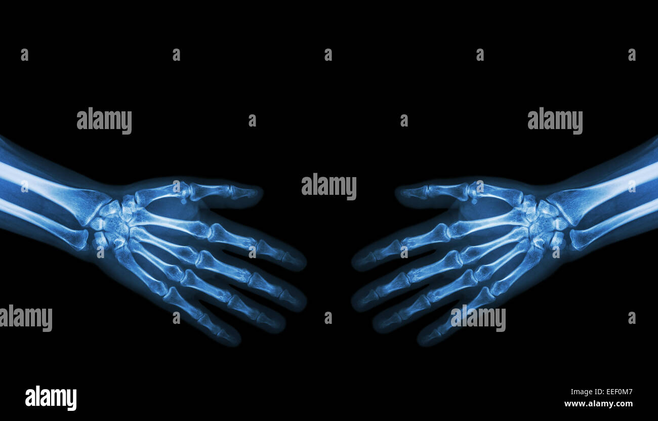 Shake hands .  X-ray normal human hands   ( blank area at upper side ) Stock Photo