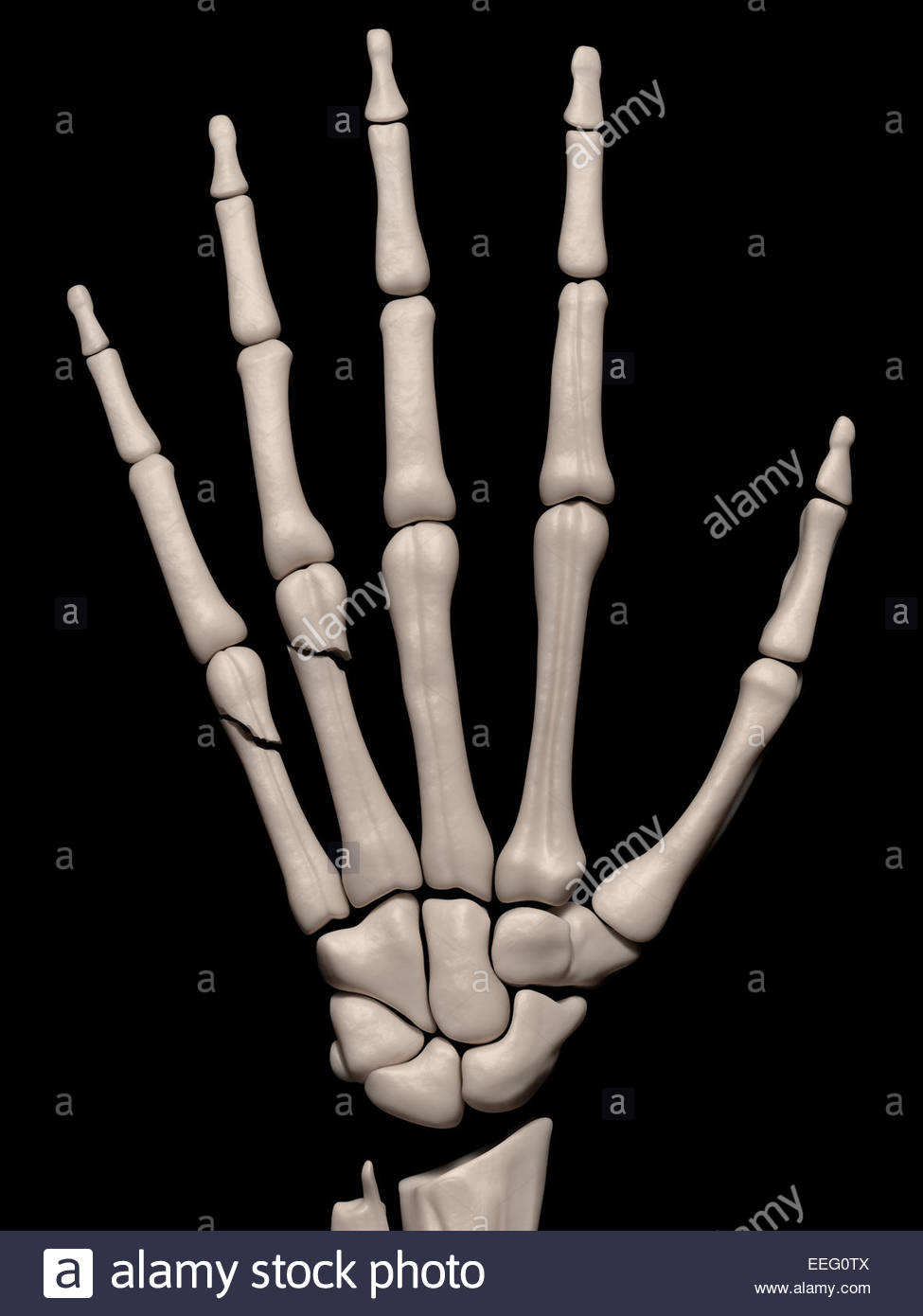 Boxers Fracture High Resolution Stock Photography and Images Alamy