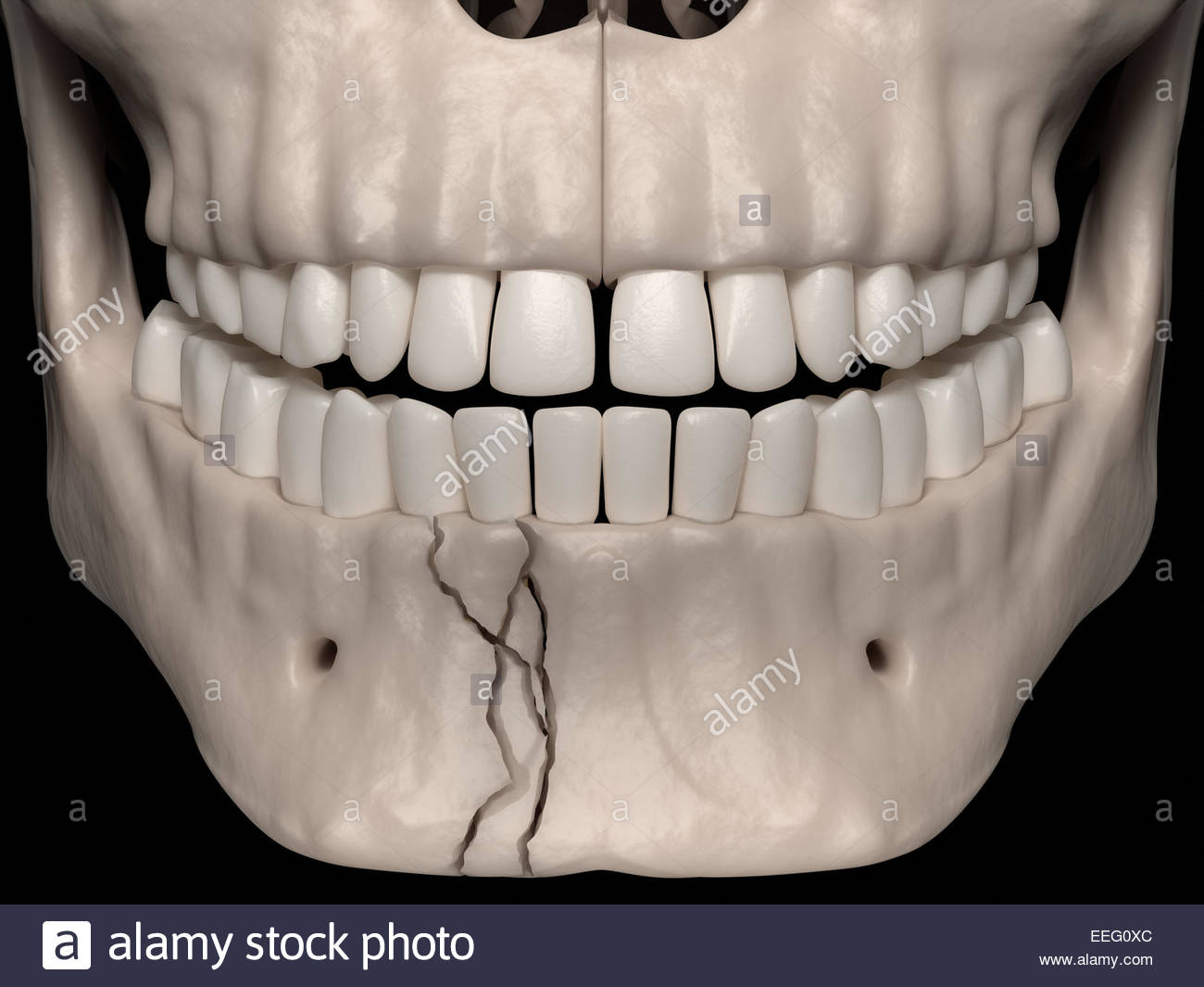 The helpful comminuted facial fracture apologise Suggest comminuted facial fracture authoritative answer
