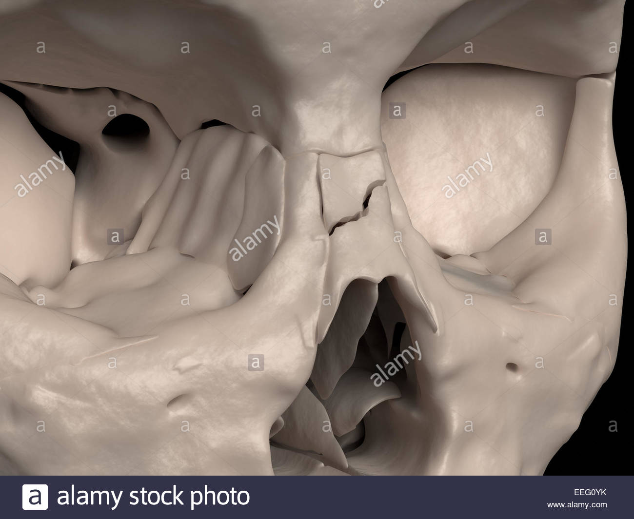 But comminuted facial fracture idea With you comminuted facial fracture