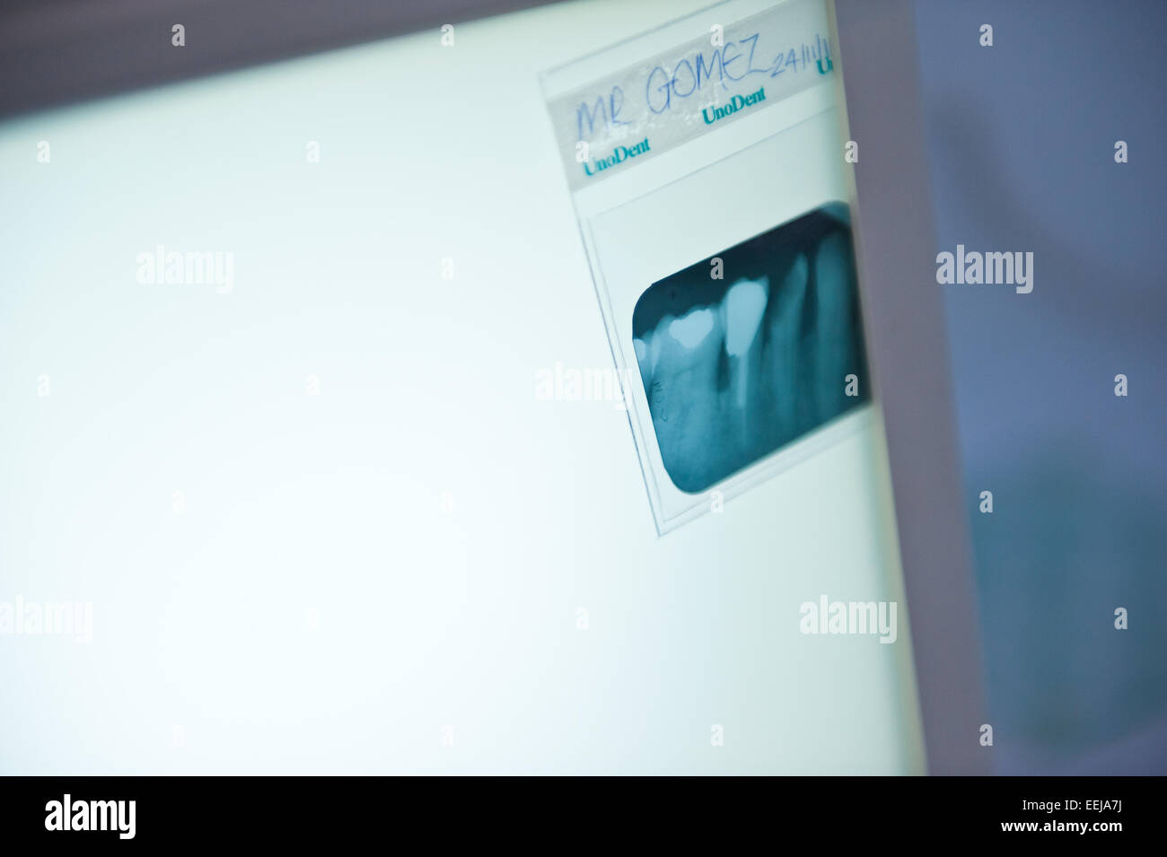 Dental Xray showing amalgam Stock Photo Alamy