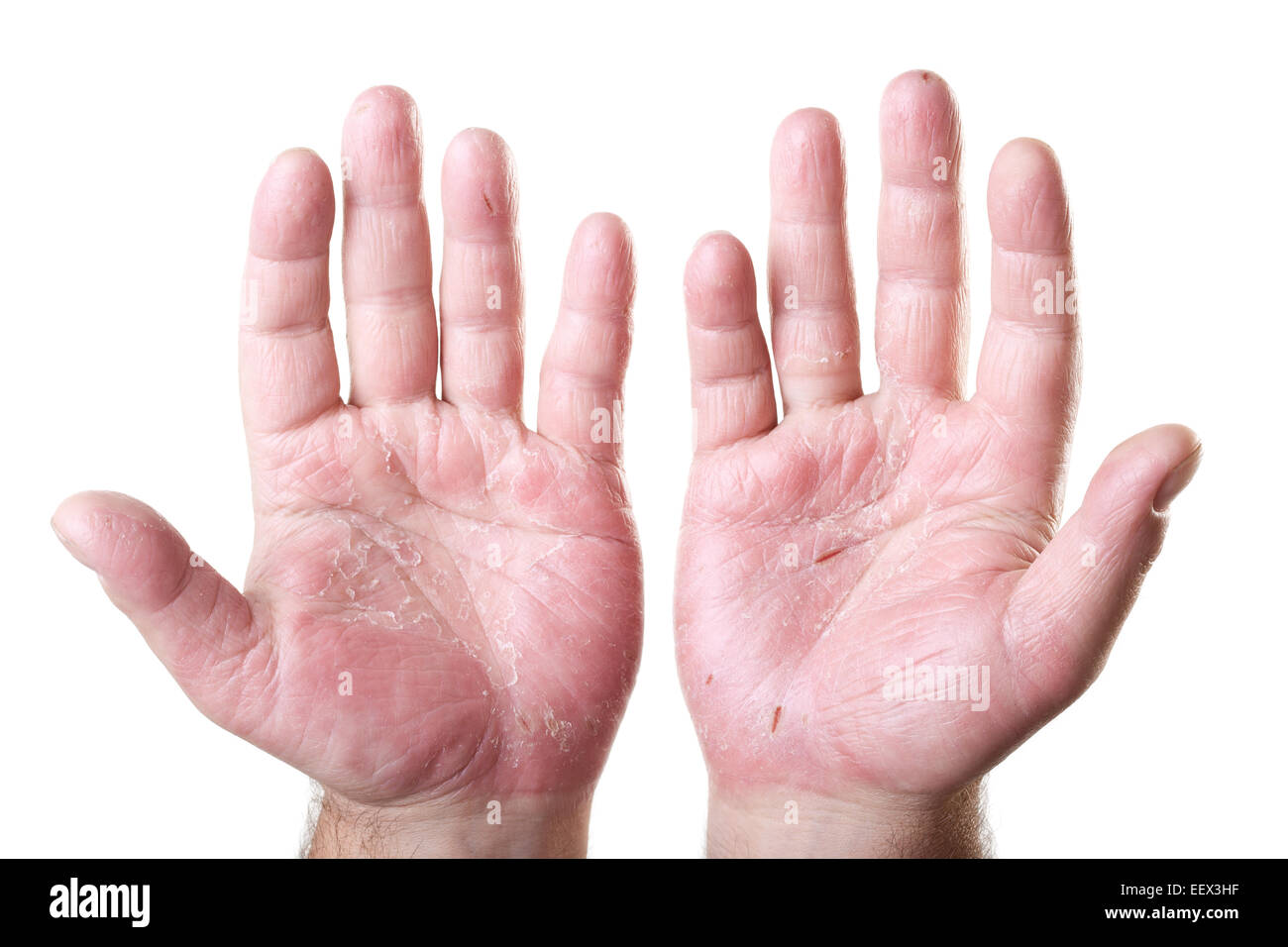 two male palms with eczema isolated on white background Stock Photo