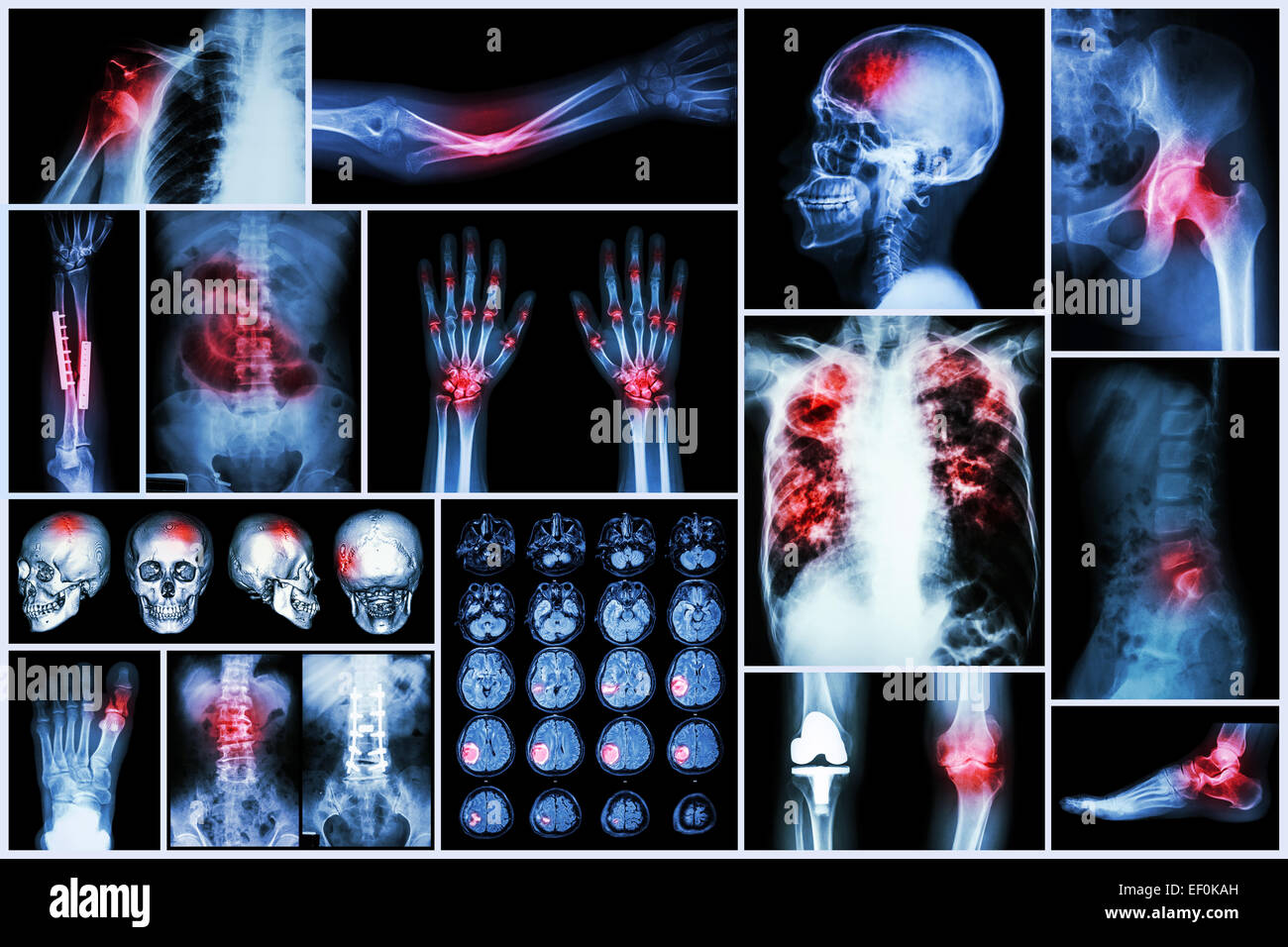 X-ray multiple disease (Stroke (cerebrovascular accident) : cva ,Pulmonary tuberculosis ,Bone fracture ,Shoulder dislocation ,Go Stock Photo