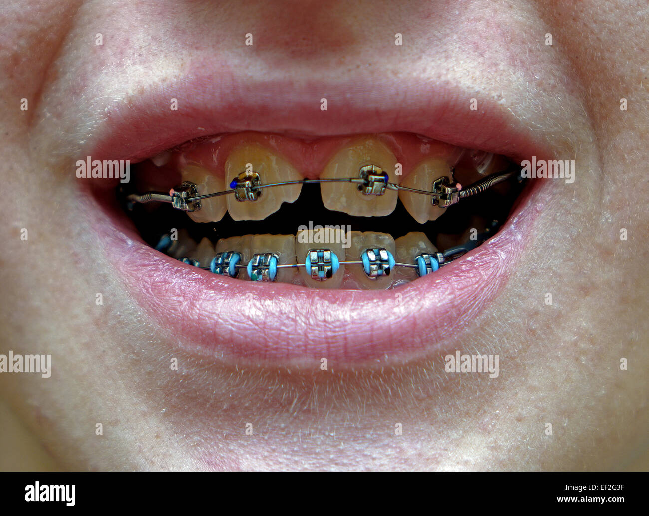 A retaining brace on a teenagers crooked teeth Stock Photo