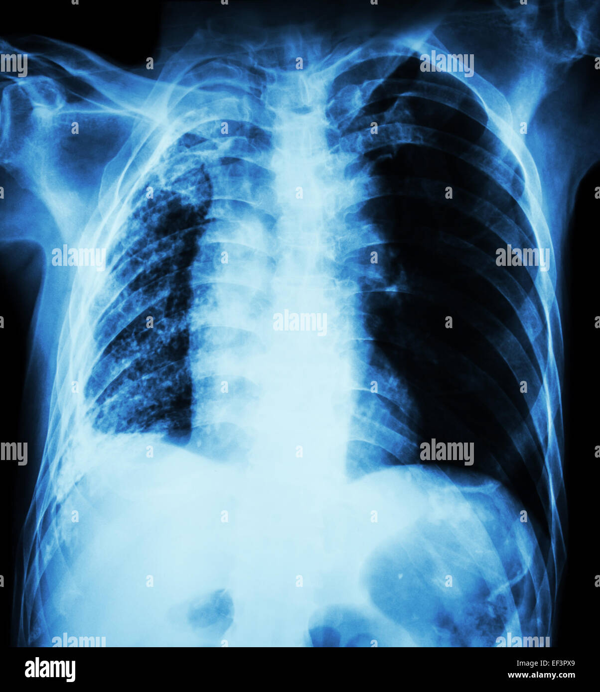 Pulmonary Tuberculosis .   Chest X-Ray : Right lung atelectasis and infiltration and effusion  due to Mycobacterium Tuberculosis Stock Photo