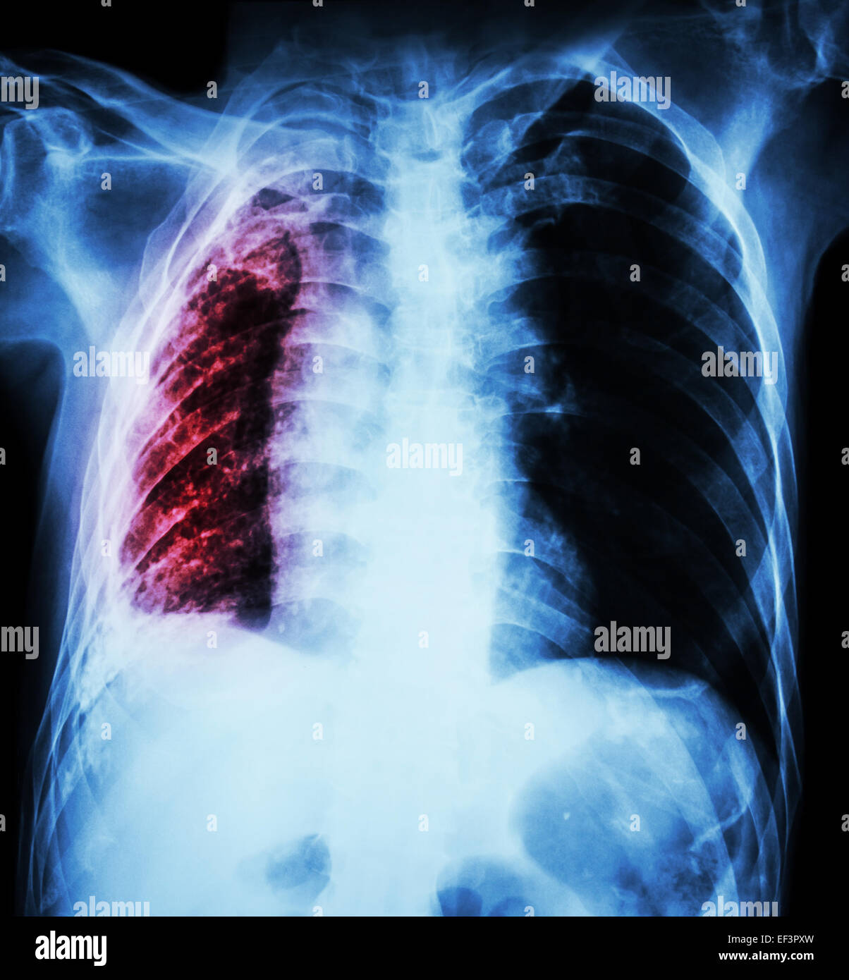 Pulmonary Tuberculosis .   Chest X-Ray : Right lung atelectasis and infiltration and effusion  due to Mycobacterium Tuberculosis Stock Photo