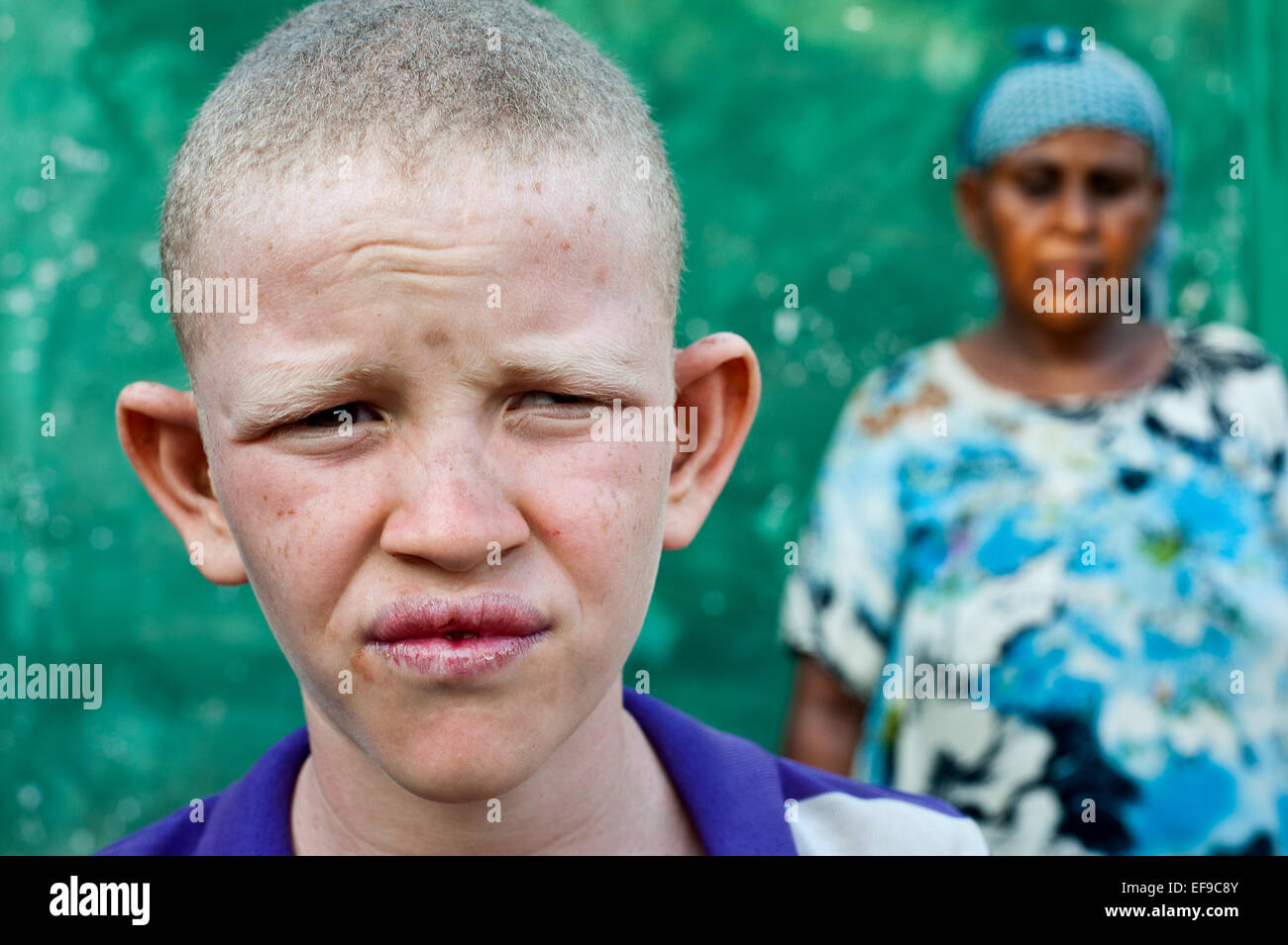 Albino boy. His mother is in the background ( Ethiopia) Stock Photo