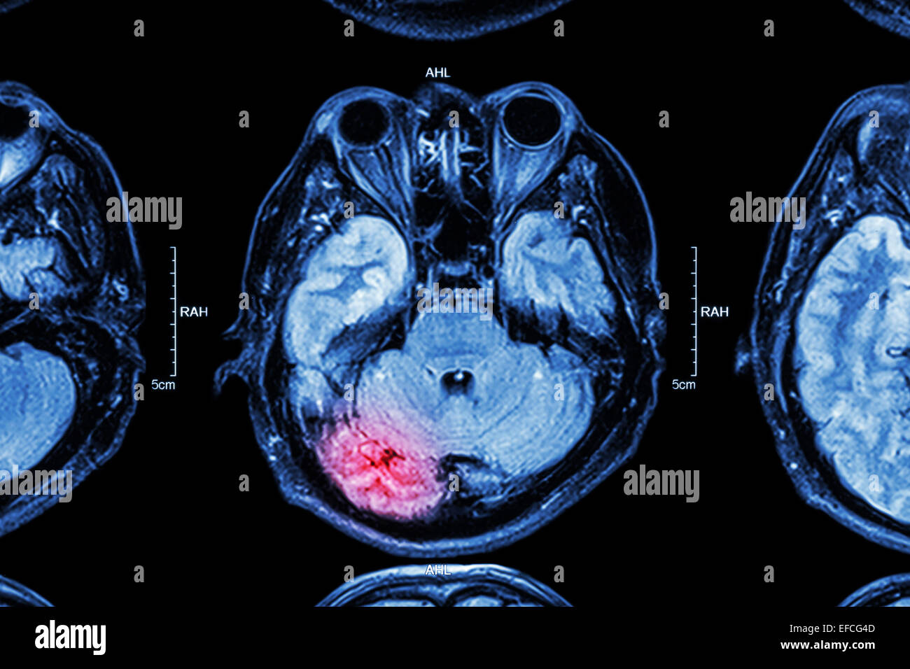 MRI of brain : brain injury Stock Photo