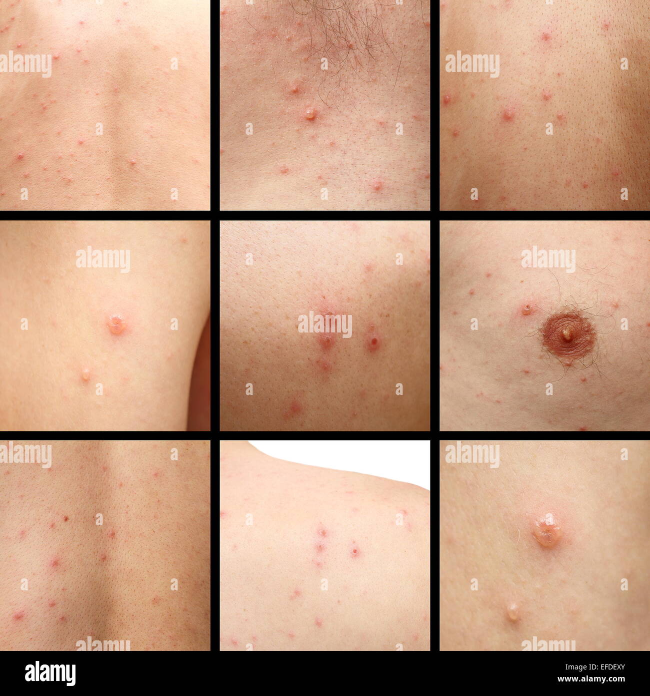 chicken pox pictures in adults