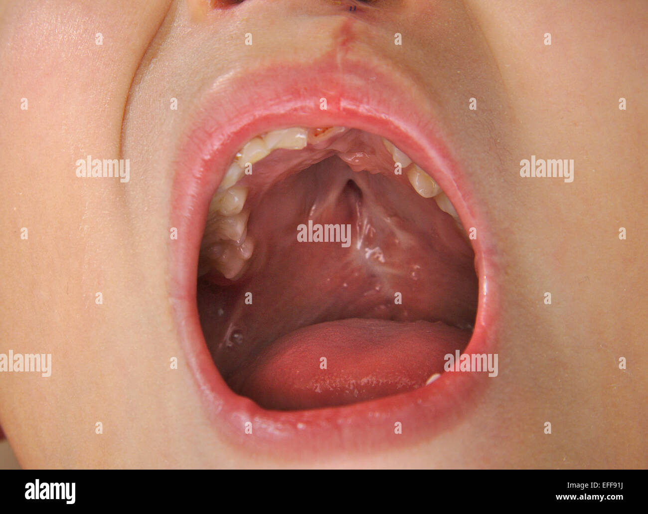 Boy showing an uvula in a cleft palate repaired Stock Photo