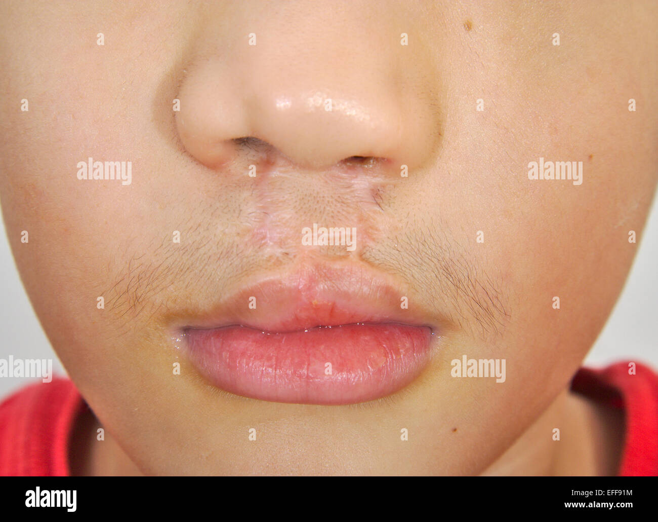 Boy showing a bilateral cleft lip repaired Stock Photo