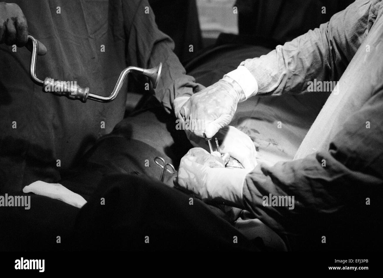 MSF surgeons perform a callus distraction on a wounded patient in Kismayo Somalia 1994 Stock Photo