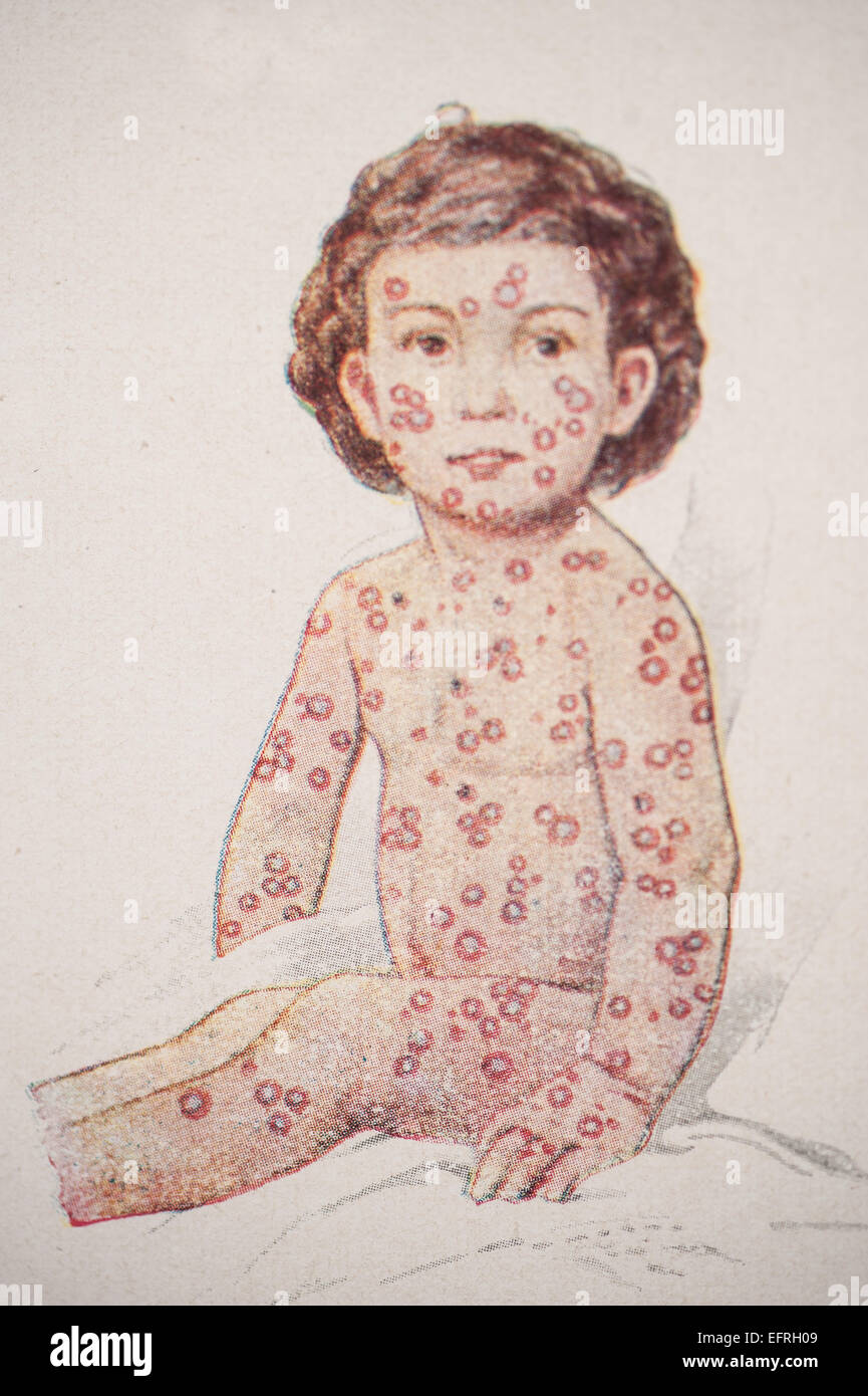 Smallpox In Kids Child with small pox, circa 1912 Stock Photo - Alamy