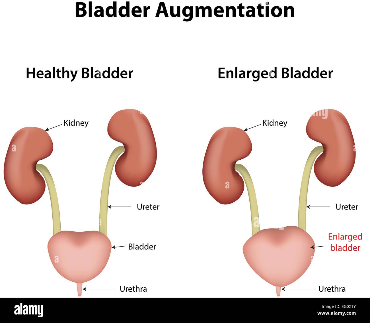 Bladder Wall Thickening What The Icd 10 Code Means For You - boiim7x