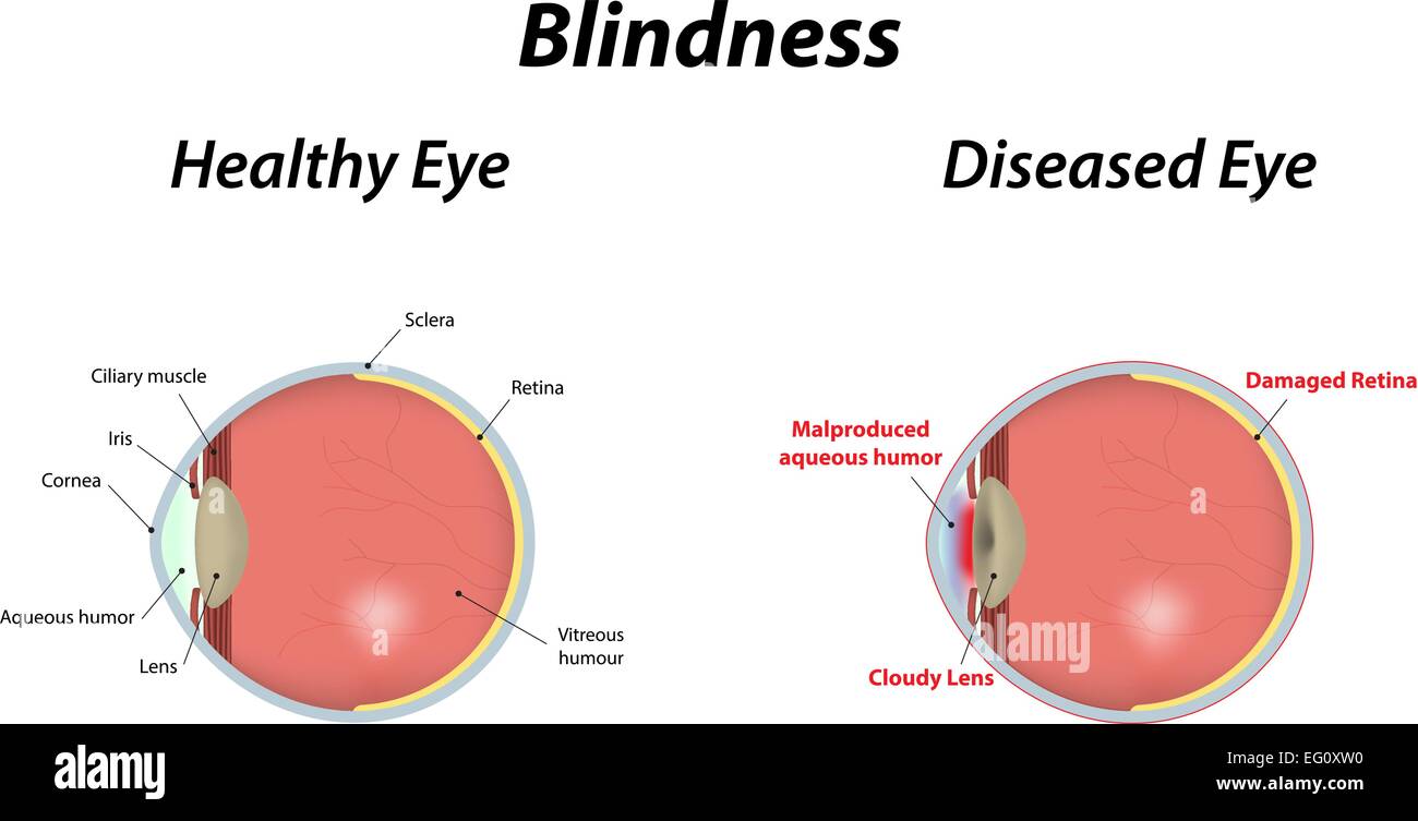 Blindness Stock Vector Image & Art Alamy