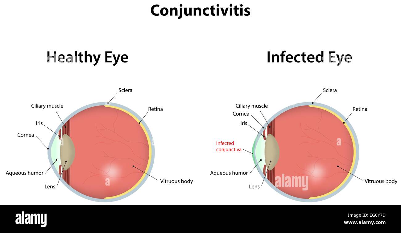 Conjunctiva hi-res stock photography and images - Alamy