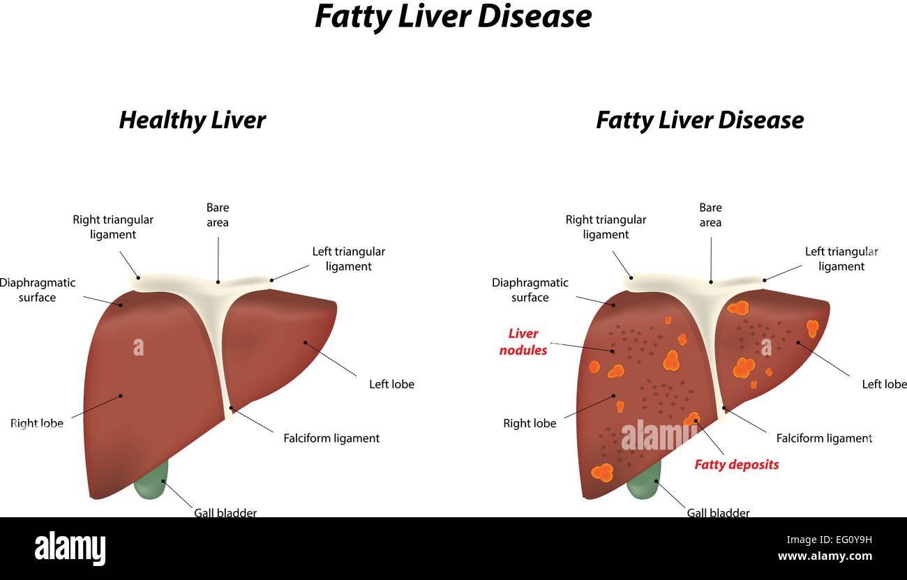Fatty Liver Disease Stock Vector