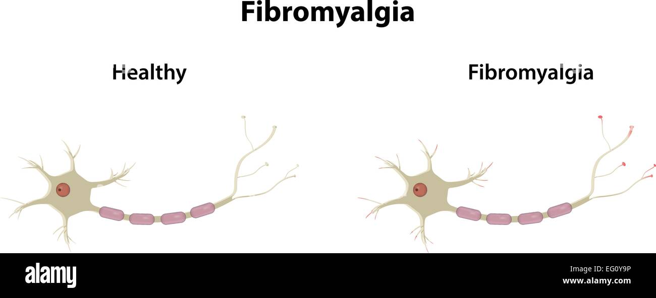 Fibromyalgia Stock Vector Images - Alamy