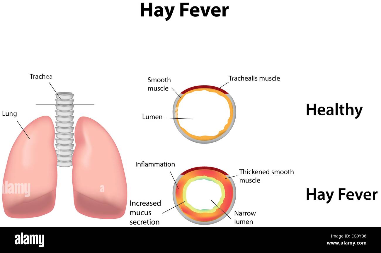 Hay Fever Stock Vector