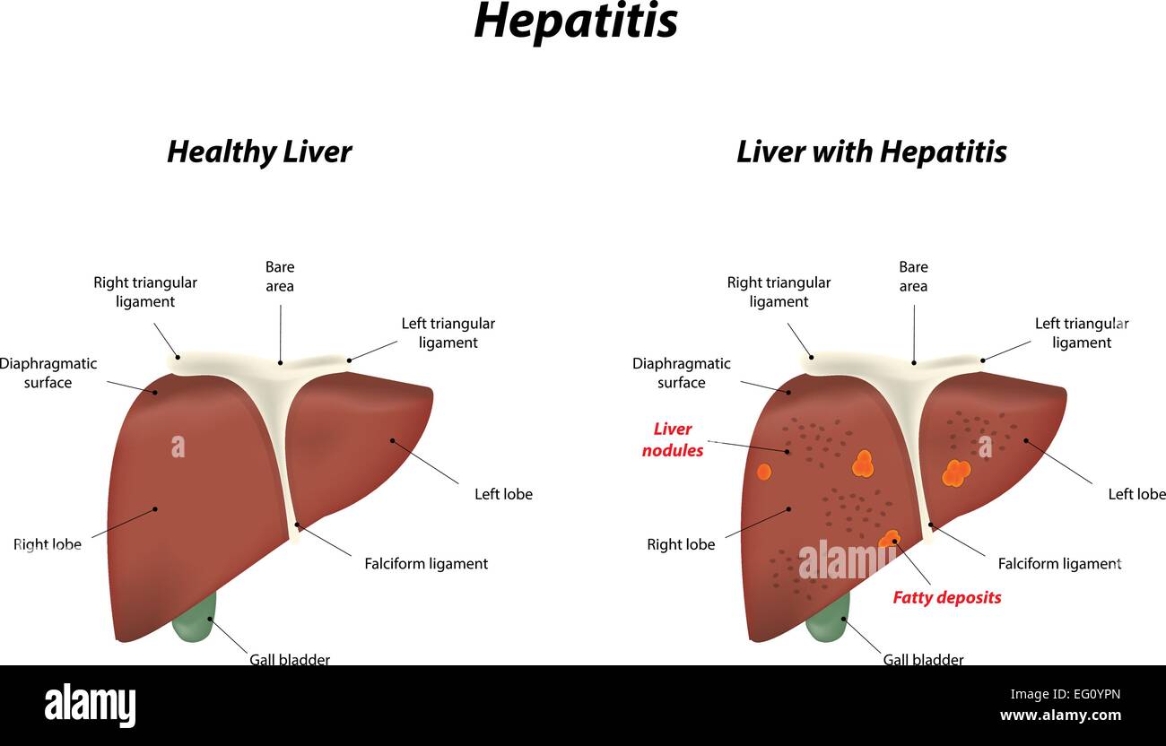 Hepatitis Stock Vector