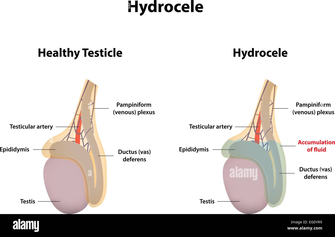 hydrocele high resolution stock photography and images alamy