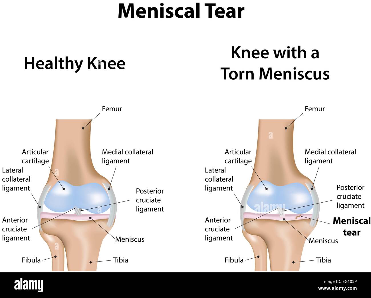 Knee Meniscal Tear Hi res Stock Photography And Images Alamy knee-meniscal-tear-hi-res-stock-photography-and-images-alamy