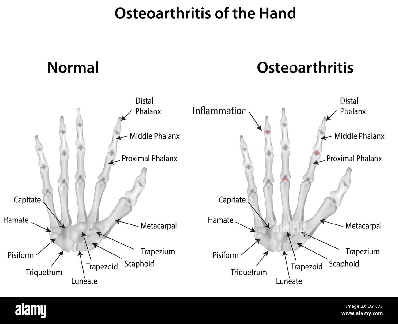 Osteoarthritis of the Hand Stock Vector Image & Art Alamy