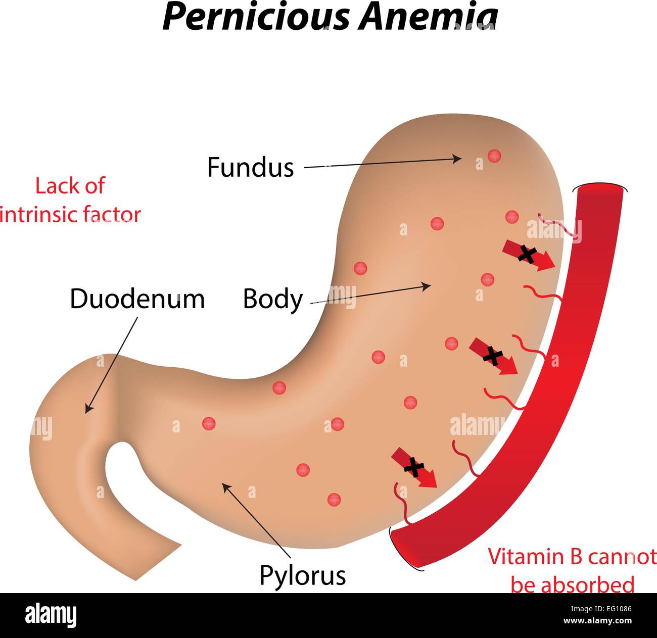 Pernicious Anemia Stock Vector
